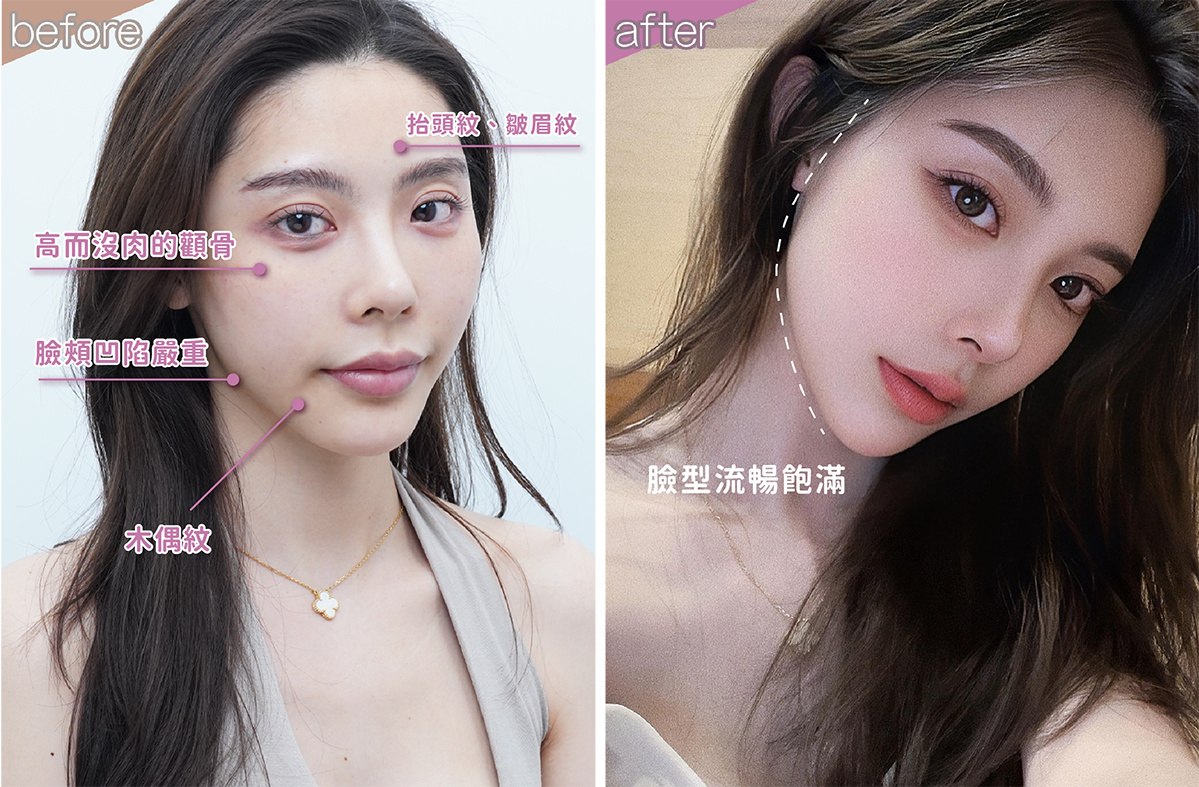 高雄湞媄診所-【4D童妍針舒顏萃Sculptra、玻尿酸、肉毒 】揮別刻薄頰凹 打造高質感貴氣面相！好評大推薦